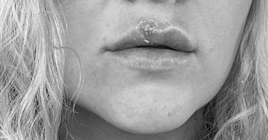 Могут ли сгореть губы на солнце. Страсть огонь. Могут ли сгореть губы на солнце. Перманент губ. Хейлит мелькерссона -розенталя.