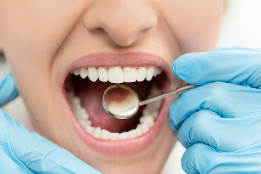 Самый вредный напиток для эмали зубов: мнение врача-стоматолога 