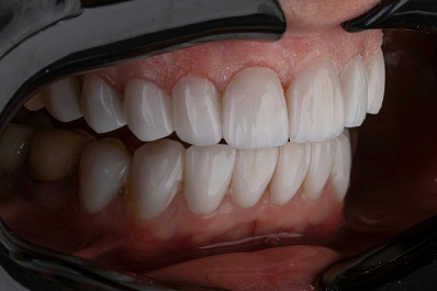 Стоматолог Ирина Назилина рассказала, почему возникает повышенная чувствительность зубов