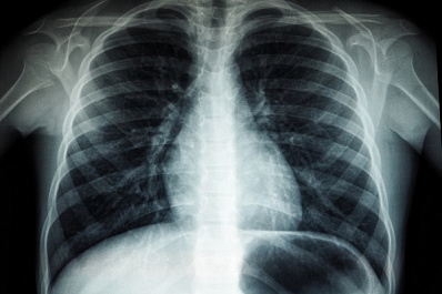 Жителя Самарской области через суд заставили сделать флюорографию