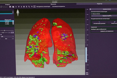 Узнать за 10 минут: самарские медики изобрели систему оценки поражения легких при COVID-19