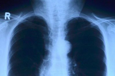 Тольяттинские врачи рассказали, как защитить себя и детей от туберкулеза