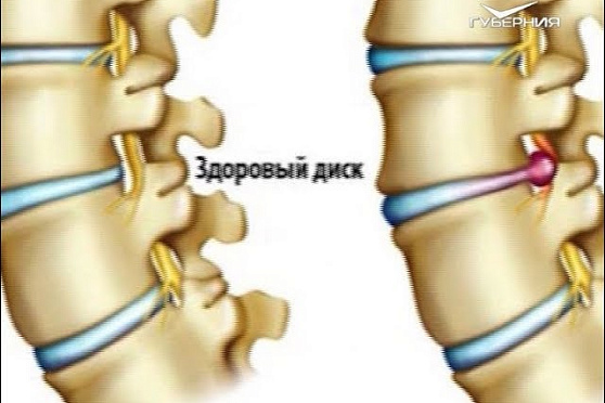 Можно ли избавиться от межпозвоночной грыжи. Школа здоровья от 29.10.2018