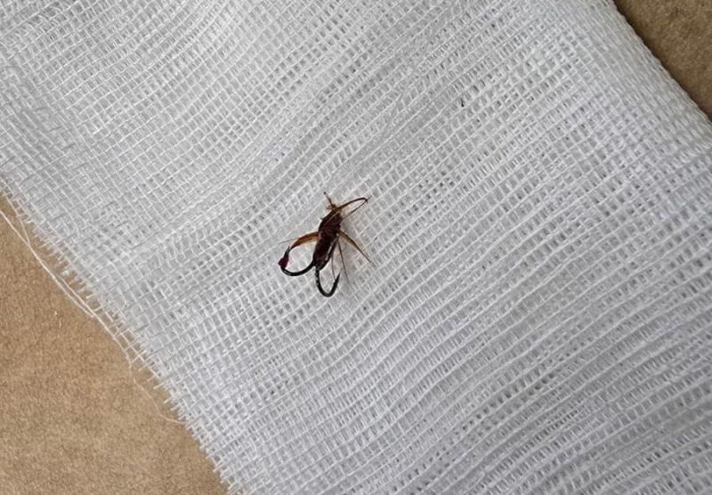 Мужчина случайно проглотил рыболовный крючок