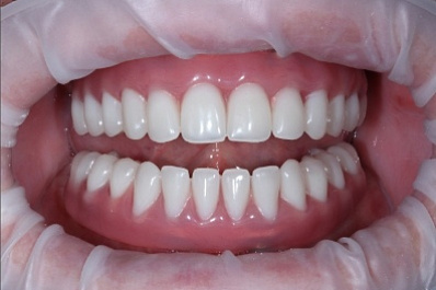 Как сделать идеальную улыбку за один день