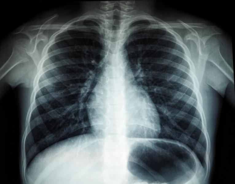 Жителя Самарской области через суд заставили сделать флюорографию