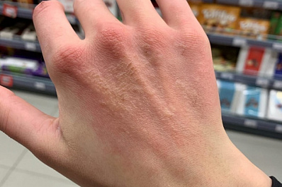 Жительница Тольятти в супермаркете сильно обожгла руки "антисептиком"