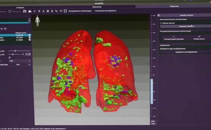 Узнать за 10 минут: самарские медики изобрели систему оценки поражения легких при COVID-19