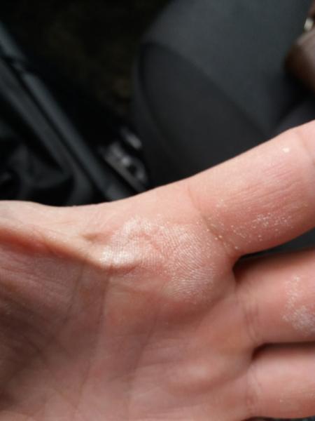 В Сызрани мужчина обжег себе пальцы детским отбеливателем