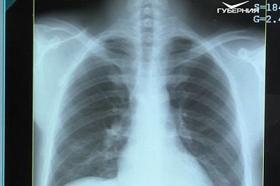 В регионе растет число пациентов с туберкулезом с множественной лекарственной устойчивостью