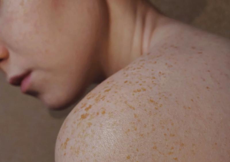Дерматовенеролог напомнил главные правила профилактики рака кожи