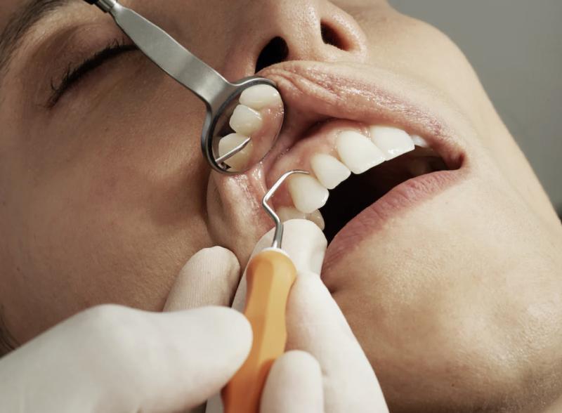 Российский стоматолог назвала причины для удаления зуба