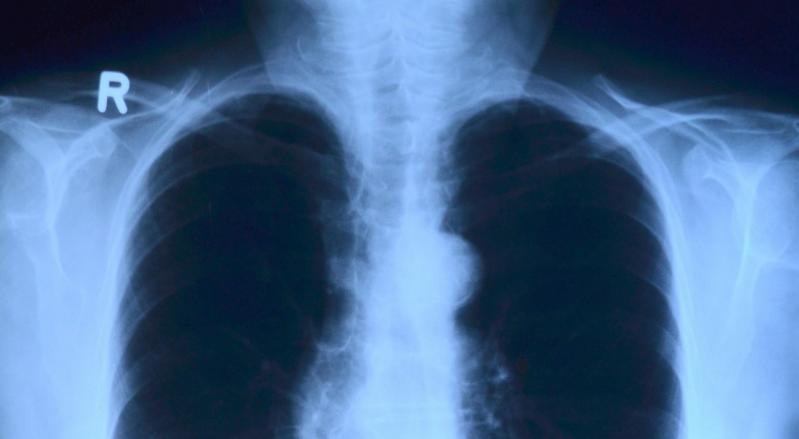 Тольяттинские врачи рассказали, как защитить себя и детей от туберкулеза