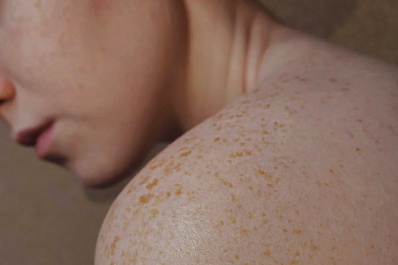 Тольяттинский врач рассказал, что может привести к злокачественным новообразованиям кожи