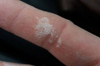 В Сызрани мужчина обжег себе пальцы детским отбеливателем