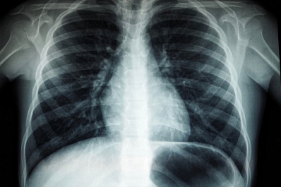 Минздрав: ранняя диагностика и скрининг - самая эффективная профилактика рака легких