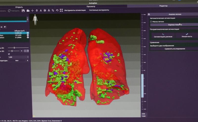 Степень поражения легких при COVID-19 определит искусственный интеллект