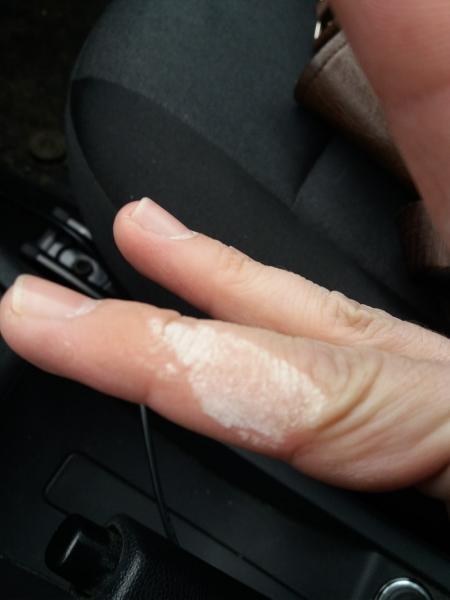 В Сызрани мужчина обжег себе пальцы детским отбеливателем