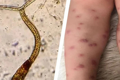 Личинки червей-паразитов атаковали отдыхающих на озере в Нижнем Новгороде