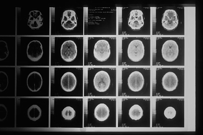 В Самарской области нейрохирурги удалили из мозга пациента гигантскую глиобластому