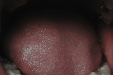 Тольяттинские врачи объяснили, как с помощью языка узнать о заболеваниях