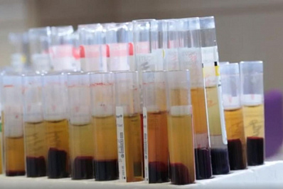 Жители Самарской области могут стать донорами костного мозга по упрощенной процедуре