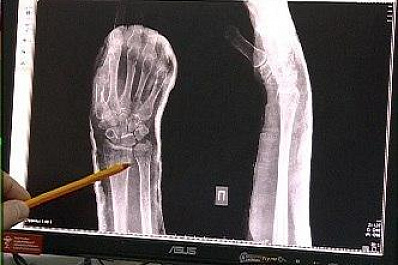 Более 1700 самарцев за новогодние праздники обратились в травмпункты