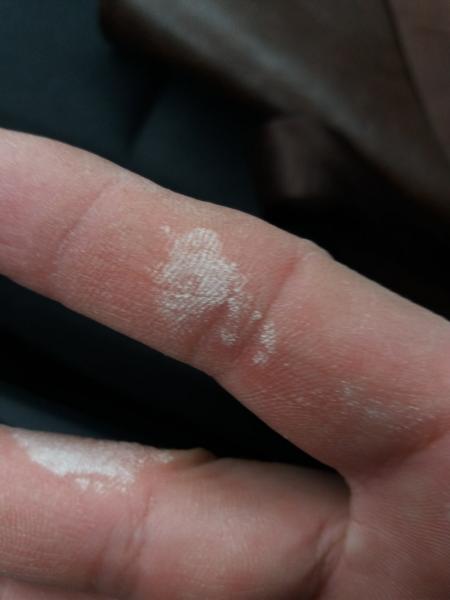 В Сызрани мужчина обжег себе пальцы детским отбеливателем