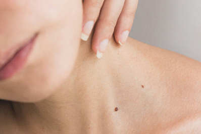 Врачи из ПФО рассказали о признаках меланомы