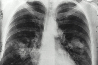 Болезнь вейперов добралась до Алтайского края