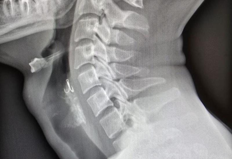 Мужчина случайно проглотил рыболовный крючок