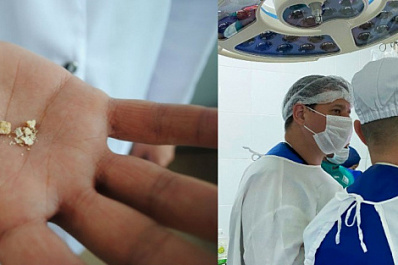 Выходят естественным путем: самарские врачи начали удалять камни из почек без скальпеля